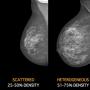 Image showing breast density