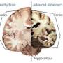 Alzheimer's disease progression